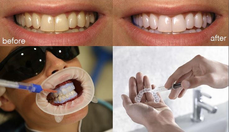 blanqueamiento dental en Bogota