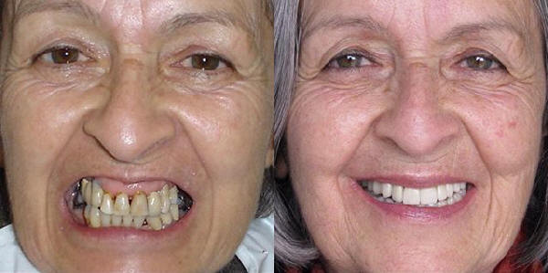 implante dental bogota